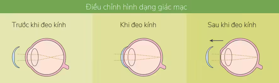 Cách kính Ortho-K hoạt động: điều chỉnh hình dạng giác mạc khi ngủ để giúp trẻ nhìn rõ vào ban ngày