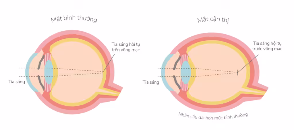Cận Thị Là Gì? Vì Sao Ngày Nay Nhiều Trẻ Bị Cận Sớm?